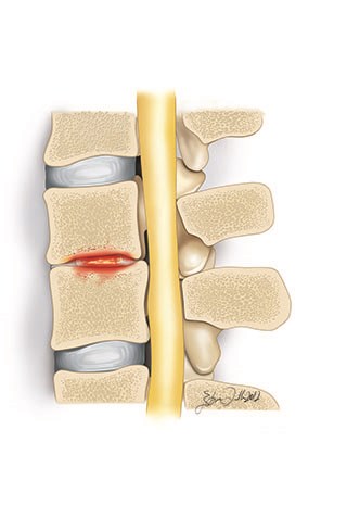 Çocuklarda omurga enfeksiyonları sıklıkla disklerden başlar