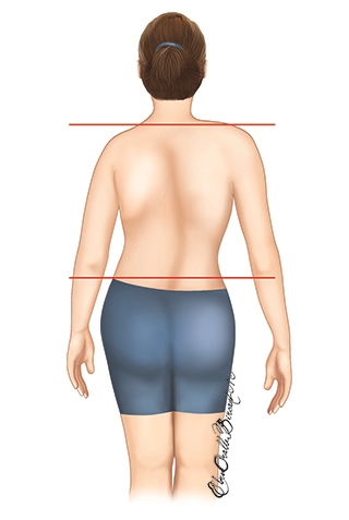 Eşit olmayan kalçalar ve omuzlar, ve bel asimetrisi