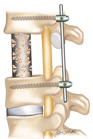 Bazı ilerlemiş omurga enfeksiyonlarında harap olmuş omurların yerine geçecek kafesler ve enstrumantasyonların kullanması gerekebilir.