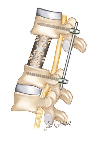 Omurilik kanalına bası yapan omurga tümörleri omurganın ön kısmına içi kemik ile doldurulmuş metal kafes yerleştirilmesi ve posteior füzyon ile tedavi edilebilir.