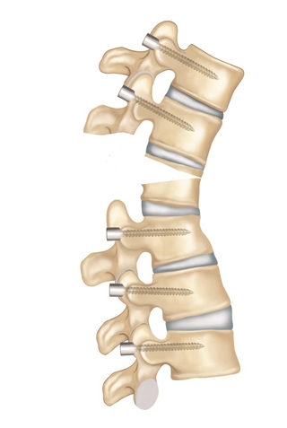Osteotomi işlemi yapılarak düzeltmeye olanak sağlayacak gerekli alan yaratılır