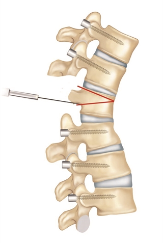 Öncelikle vidalar yerleştirilir ve düzeltme için çıkarılması gereken kemik hesaplanarak osteotomi hatları belirlenir.