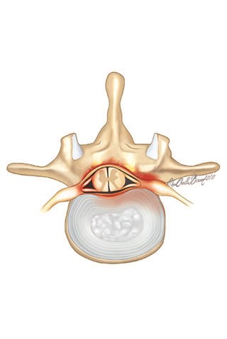 Fıtıklar veya eklemlerde bozulmalar nedeniyle sinir köklerinin çıktığı foramen bölgeleri de daralabilir.