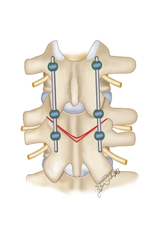 Osteotomi bölgesinin kemik teması sağlanacak şekilde kapatılmasının şematik görünümü