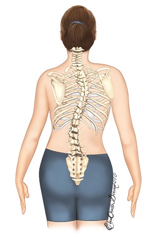 The most common type of scoliosis is idiopathic scoliosis