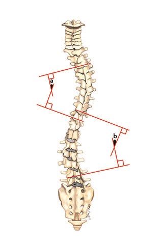 Manual or computerized Cobb angle measurements of the scoliosis