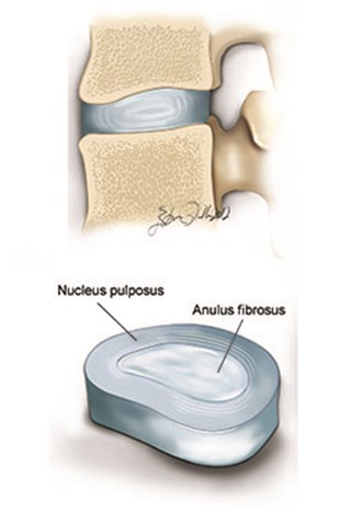 The discs are composed of a strong outer layer named "annulus fibrosus", and a gelly-like substance in the core, named "nucleus pulposus"