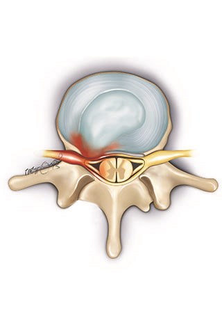 The outer layer may rupture with further degeneration of the disc which may result in the overflowing (disc herniation or rupture) of the disc core through a tear in the outer layer and into the space that carries the nerves and spinal cord
