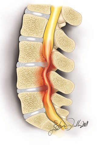 With the lumbar disc herniation diagnosed with spinal stenosis, the canal will become narrower and the complaints of the patients increase.