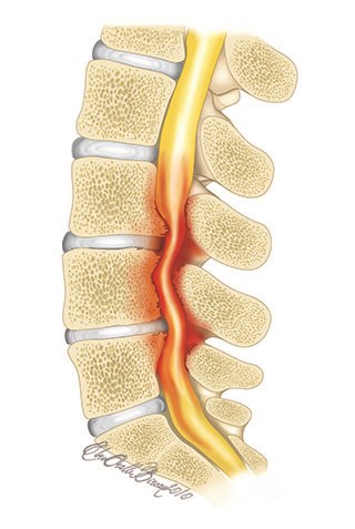 Symptoms of lomber spinal stenosis are loss of sensation or power in the legs or leg cramps. The most typical symptom is pain and weakness in the leg after walking for a distance.