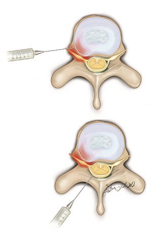 95%-97% of lumbar disc hernia can be treated non-surgically.
