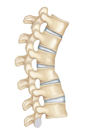 In some complex deformities and previously fused spines, osteotomy procedure is required to maintain the normal spinal alignment