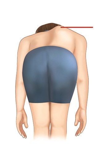 A clear hump appearance in forward bending