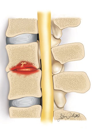 If not treated, spinal infections can spread to the bones