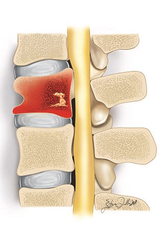 Spinal infections can start from the bones