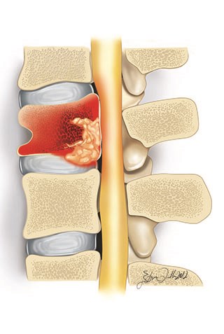 If not treated, spinal infections can spread to the discs and spinal canal