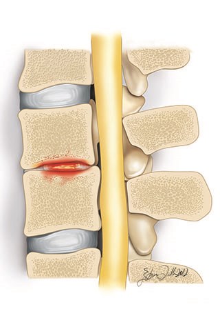 Spinal infections can begin from the discs