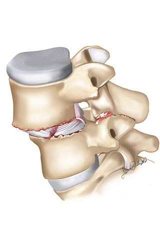 Spondylolisthesis is the forward slippage of a vertebra on top of the other one. Treatment options differ by the type and amount of the slippage, and the complaints of the patient.