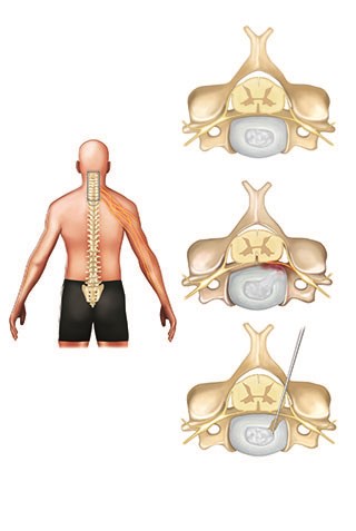 Less commonly, posterior cervical disc herniation surgeries are performed