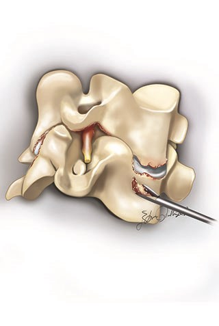 The hernia is accessed through a skin incision on the front or back  of the neck