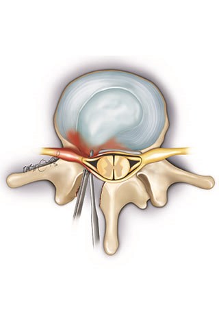 The herniated disc and other torn pieces are removed