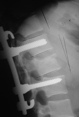 In the fracture treatments, spinal vertebrae alignment is as important as fracture stabilization.