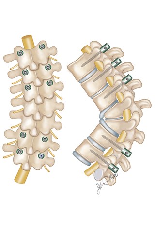 Hemivertebrae based on their locations on the spine, may cause big curves on pediatric patients