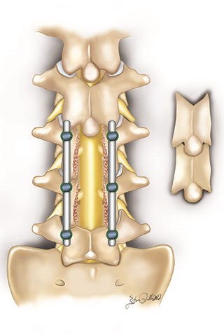 The vertebrae are stabilized by using screws and rods