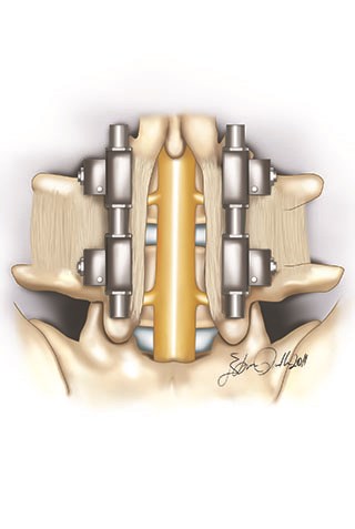 For the long term surgical effectiveness, fusion between the stabilized bones is required
