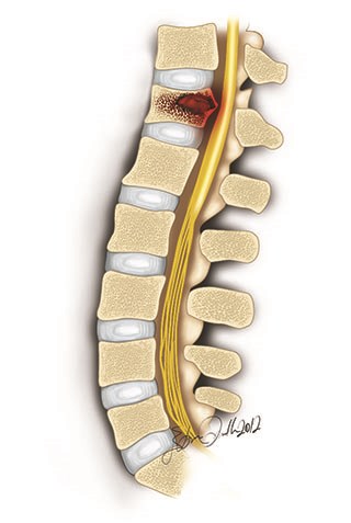spinal tumors may grow through the spinal canal and cause spinal canal compression symptoms