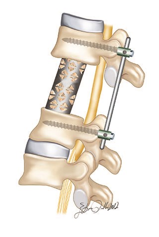 Spinal tumors causing spinal compression are surgically treated by placing anterior cage and posterior fusion application.