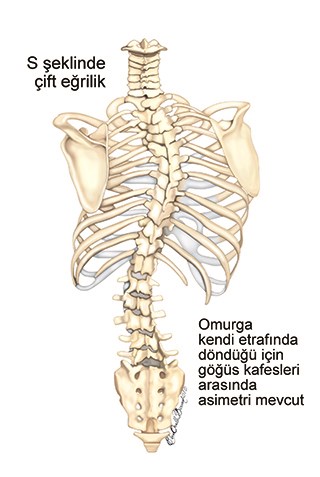 S-shaped double-curved scoliosis