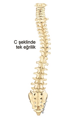C-shaped single-curved scoliosis