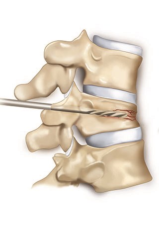In kyphoplasty technique, a space is created in the fractured area of the bone