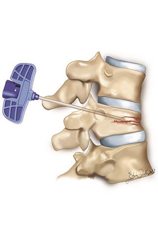 In vertebroplasty technique, A canule is used to reach to the fractured area.