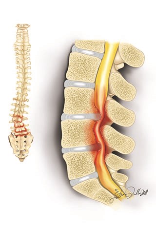Adult scoliosis can be observed with spinal stenosis symptoms