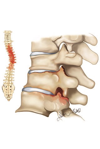 Adult scoliosis can be observed with degenerative changes of the spine