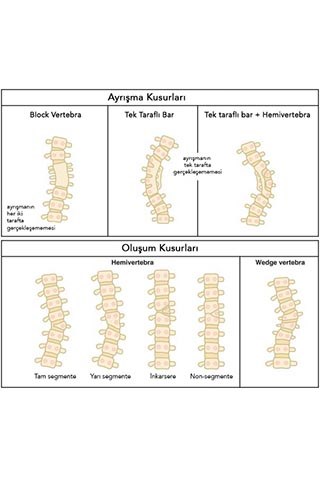 Formation and seperation anomalities cause congenital scoliosis