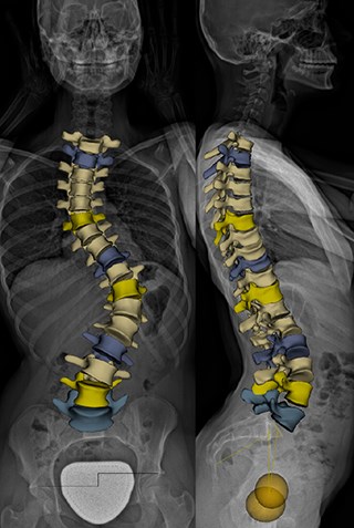 Scoliosis is 8 to 10 times more common in girls than boys